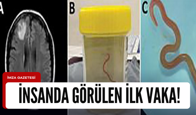 Dünyada ilk! Bir hastanın beyninden canlı solucan çıkarıldı...