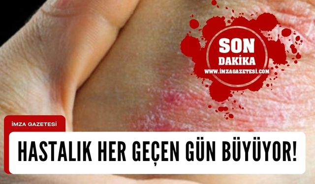 Sedef Hastalarının Psiko-Sosyal Yükü Her Geçen Gün Büyüyor...